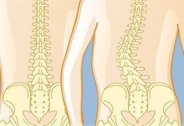 اصلاح انحرافات ستون فقرات